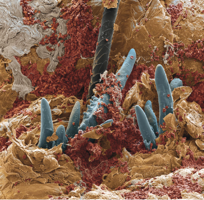 Demodex: Μια άγνωστη απειλή